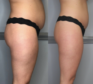 Cryoslimming before and after