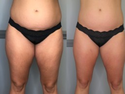 Cryoslimming results for abdomen