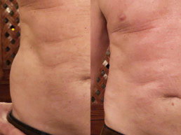 Love-Handles-Before-After-1