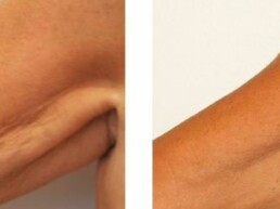 B&A of woman's arm tightening