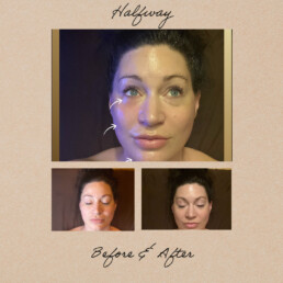 cryo facial photos