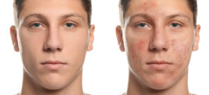 Before and after photos of young man with acne and clearer skin